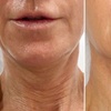 Image 5: Morpheus 8 Face and Neck / Abdomen or Butt Treatment at No Pain All Gain Spa (Up to 37% Off)