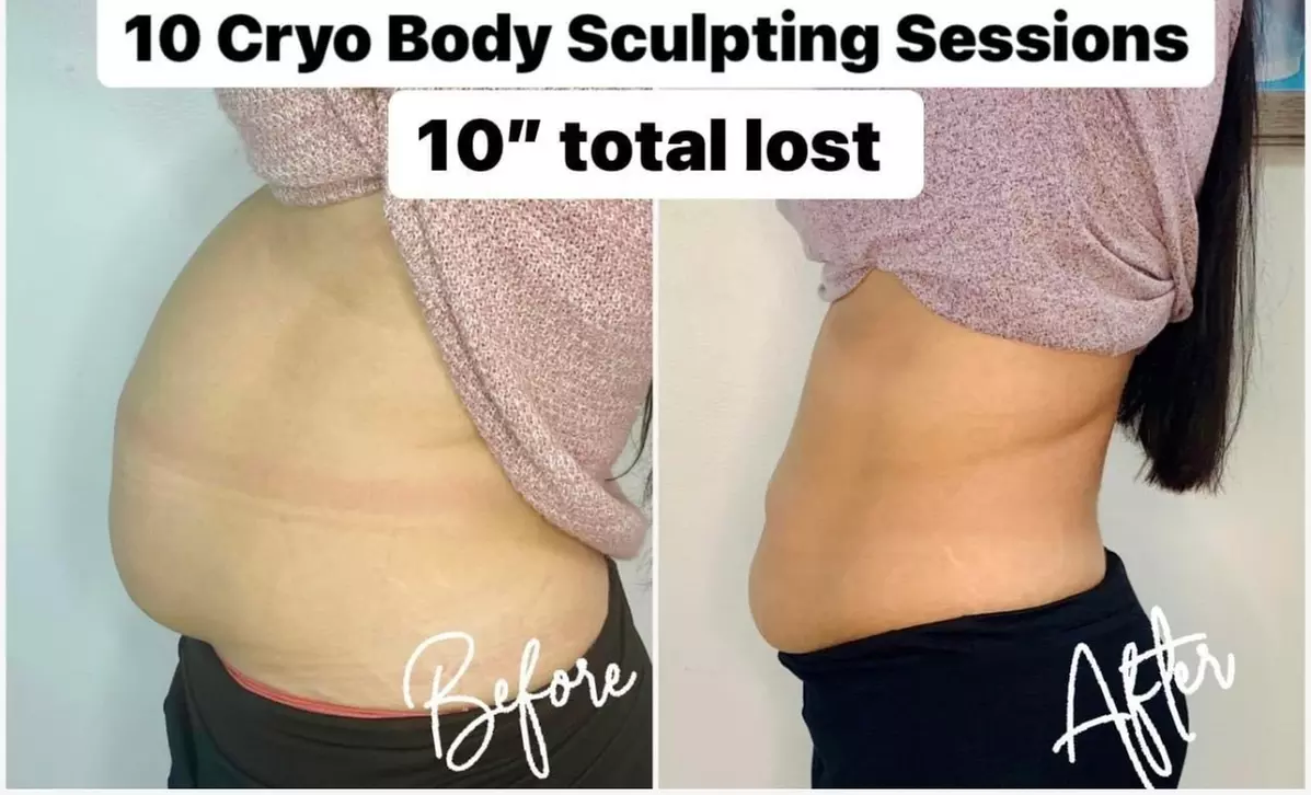 Up to 57% Off on Cryotherapy at Suite Spot MedSpa - Primary Image