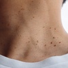 Image 4: Up to 50% Off on Plasma Pen Treatment at Gentlelase Laser Aesthetics