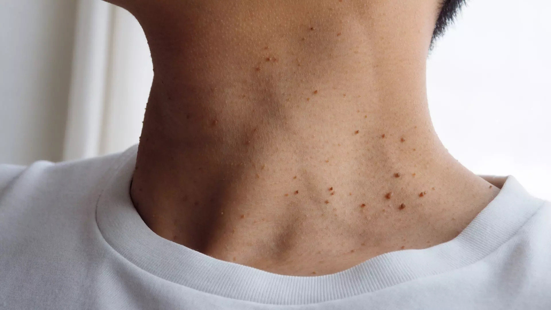 Plasma Pen for Skin Tags, Spots & Milia: Choose 5, 10, or 10+ Removals
