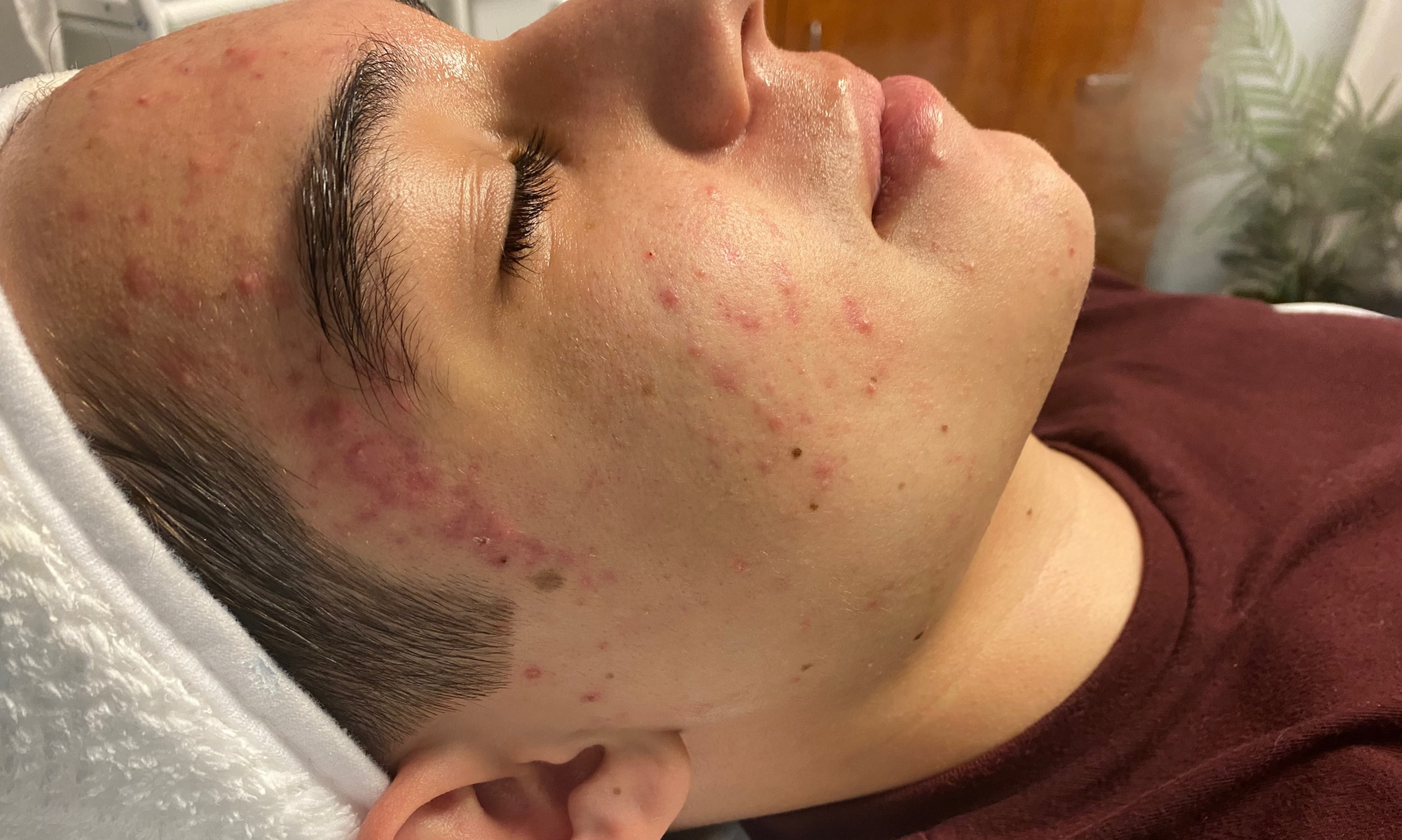Up to 33% Off on Acne Treatment at Skintology Skin & Laser Spa