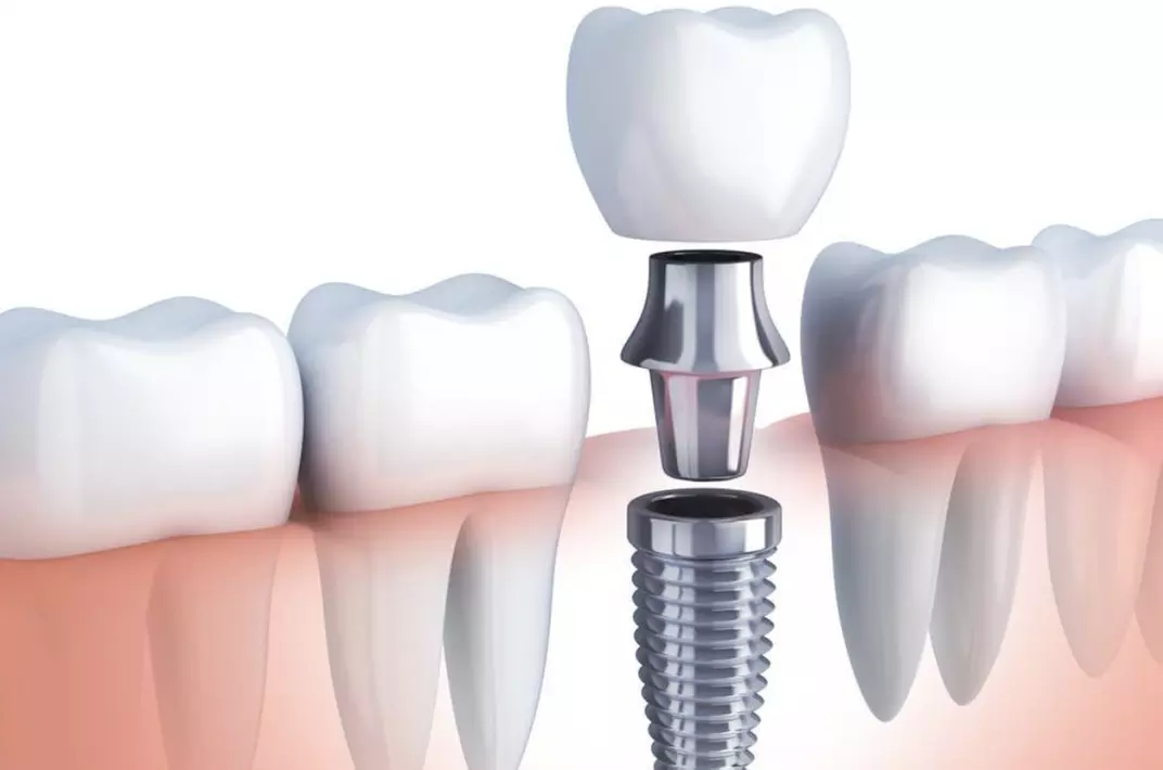 Up to 44% Off on Dental Implant at U Dream Dental Garden Grove - Primary Image