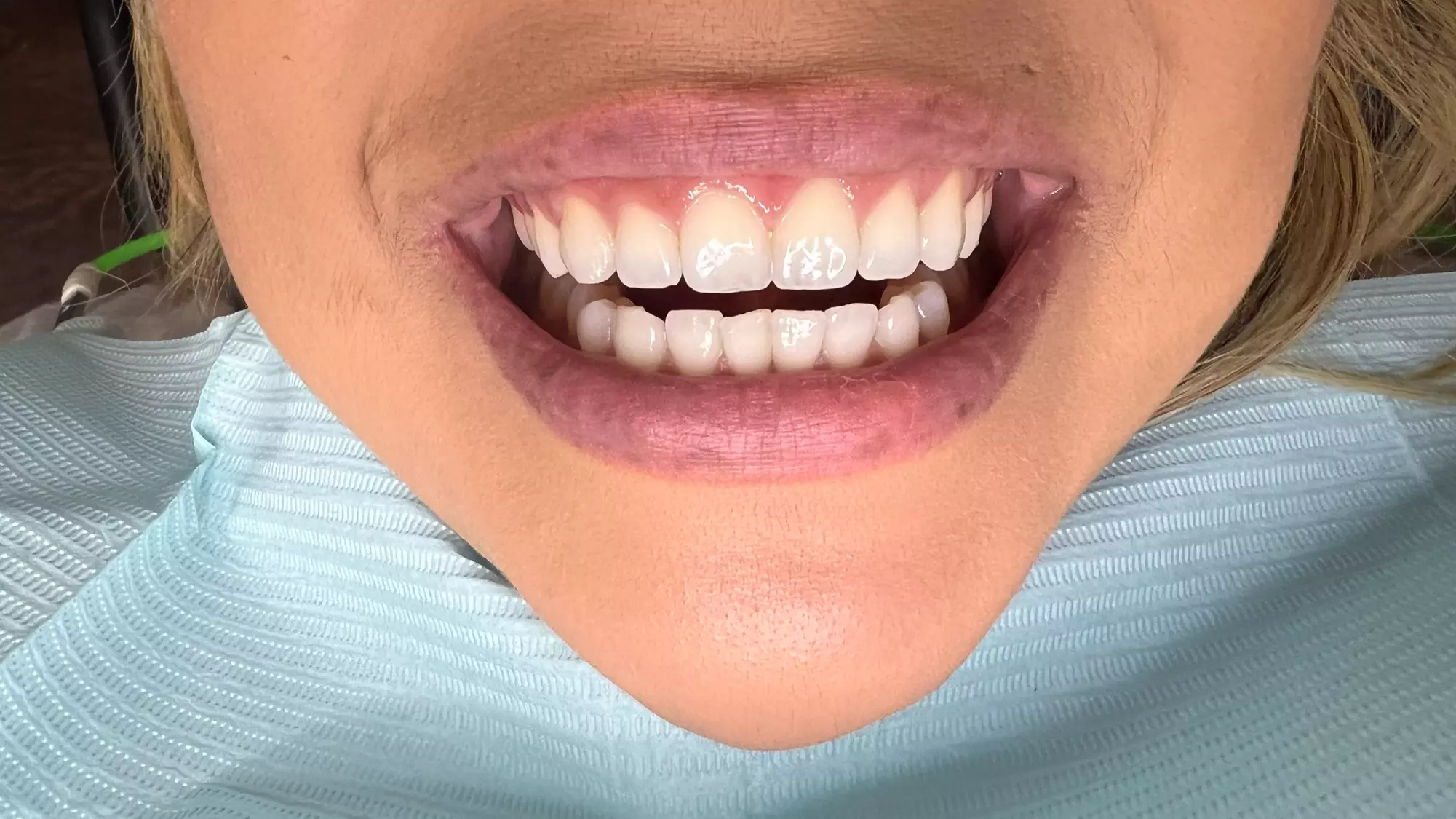 Up to 58% Off on Teeth Whitening at New Smile Cosmetics LLC - Second Medium
