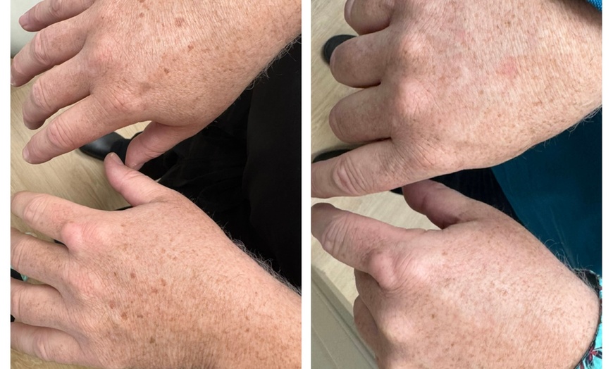 Image 3: Revitalize Your Skin with IPL Photo Facials for Full Face w/w/o Neck