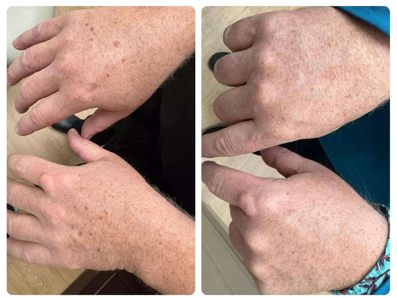 Revitalize Your Skin with IPL Photo Facials for Full Face w/w/o Neck