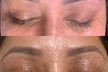 Up to 50% Off on Facelift - Non-Surgical at About Face Esthetics - Second Medium