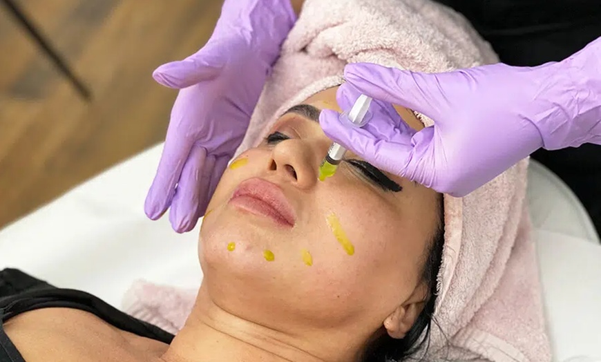 Image 1: Up to 45% Off on Facial - Chemical Peel at UK Aesthetics Lounge