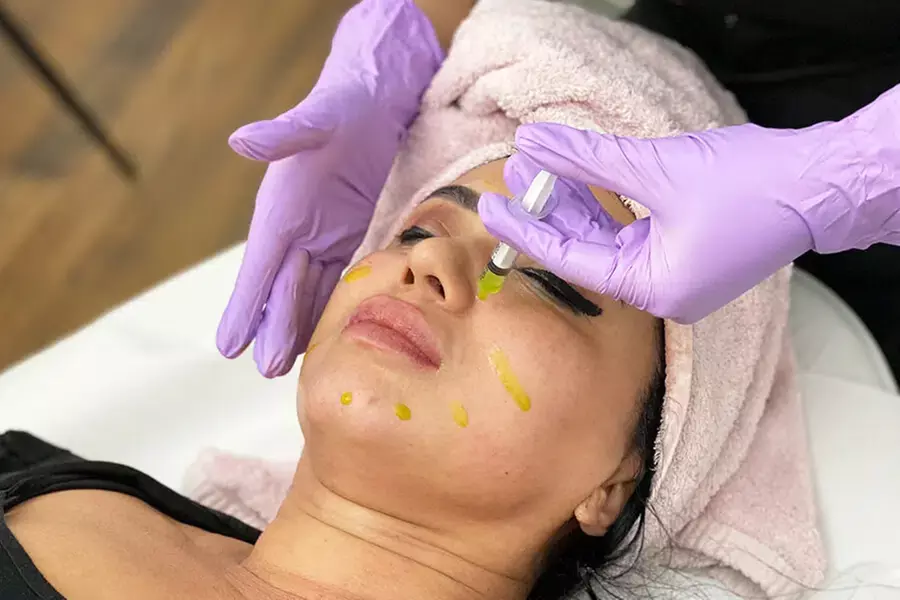 Up to 66% Off on Facial - Chemical Peel at UK Aesthetics Lounge