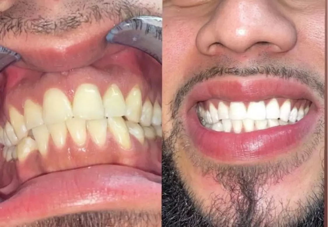 Up to 50% Off on Teeth Whitening at K And A Styles - Primary Image