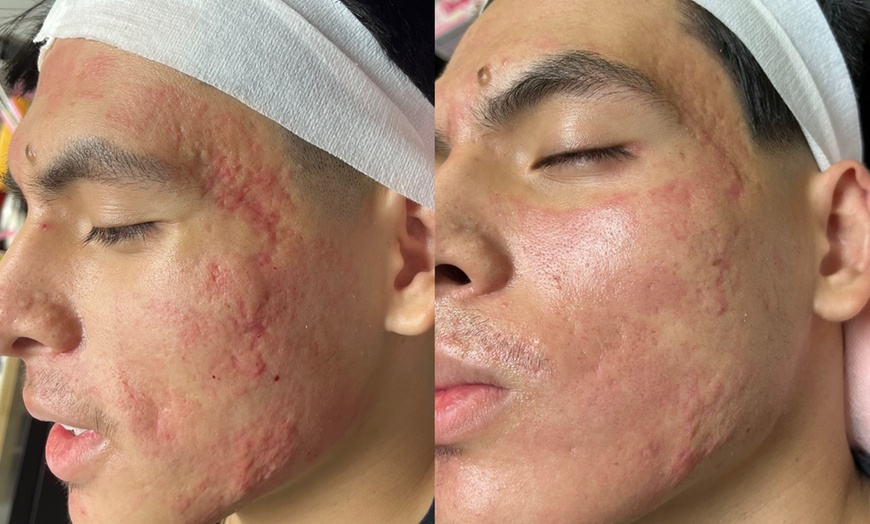 Image 2: Transform Your Look With One or Two Micro-Needling Treatments