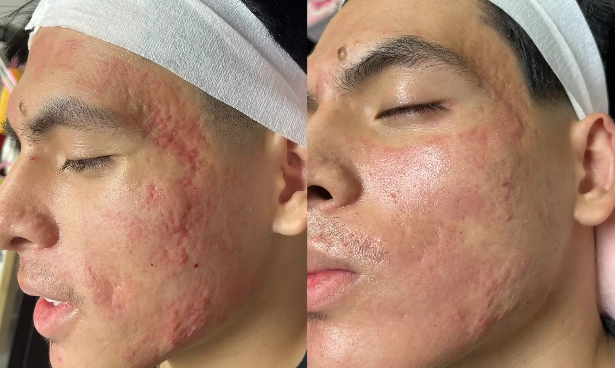Transform Your Look With One or Two Micro-Needling Treatments