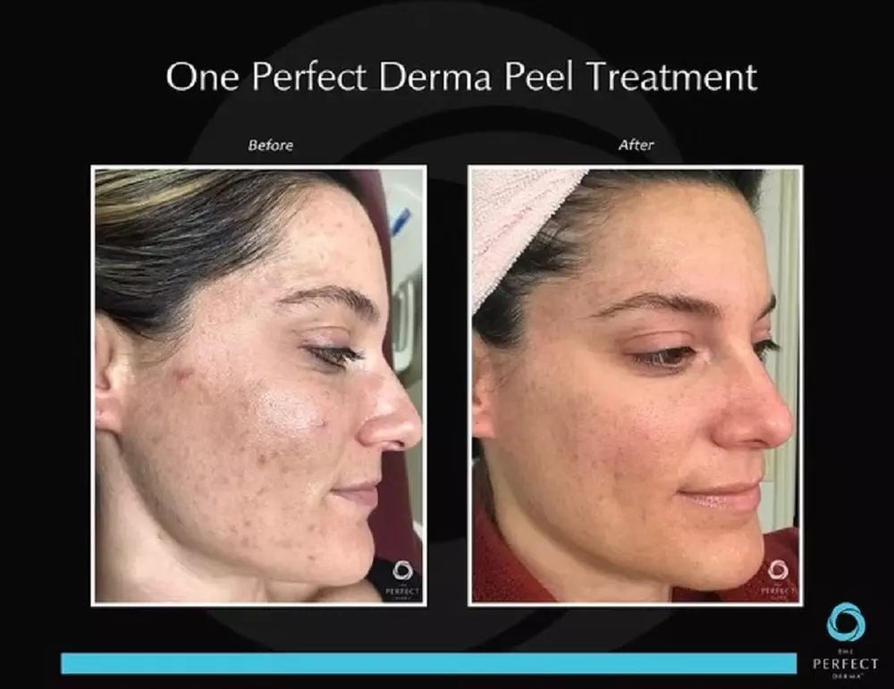 Beauty Week Special: Perfect Derma Peel Single Treatment for Smooth and Youthful Skin ( Up to 50% Off ) - Primary Image