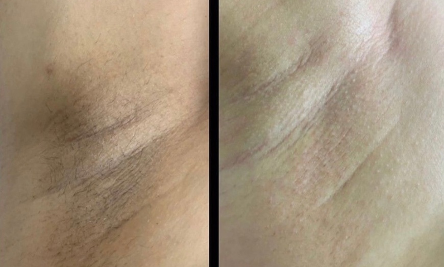 Image 3: Up to 87% Off on Laser Hair Removal at Aesthetics Care Med Spa