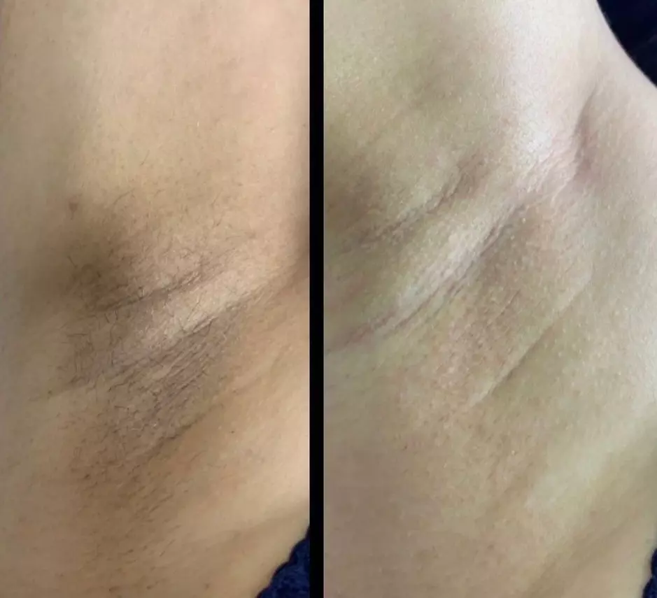Up to 87% Off on Laser Hair Removal at Aesthetics Care Med Spa