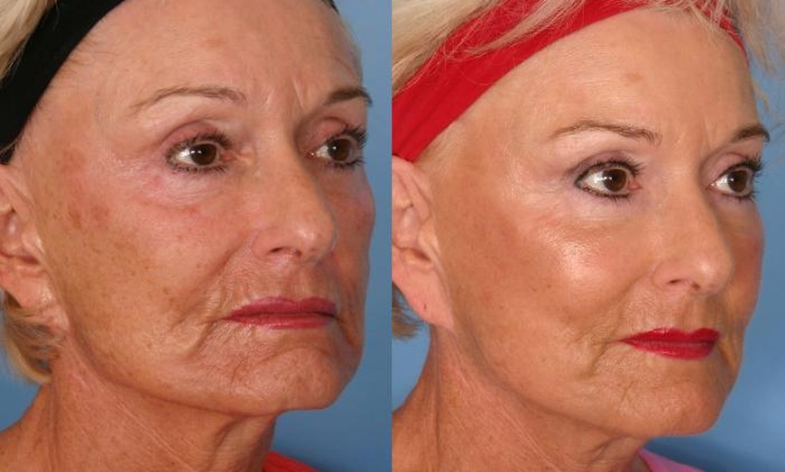 Image 2: Morpheus 8 Face and Neck / Abdomen or Butt Treatment at No Pain All Gain Spa (Up to 37% Off)