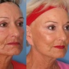 Image 2: Morpheus 8 Face and Neck / Abdomen or Butt Treatment at No Pain All Gain Spa (Up to 37% Off)