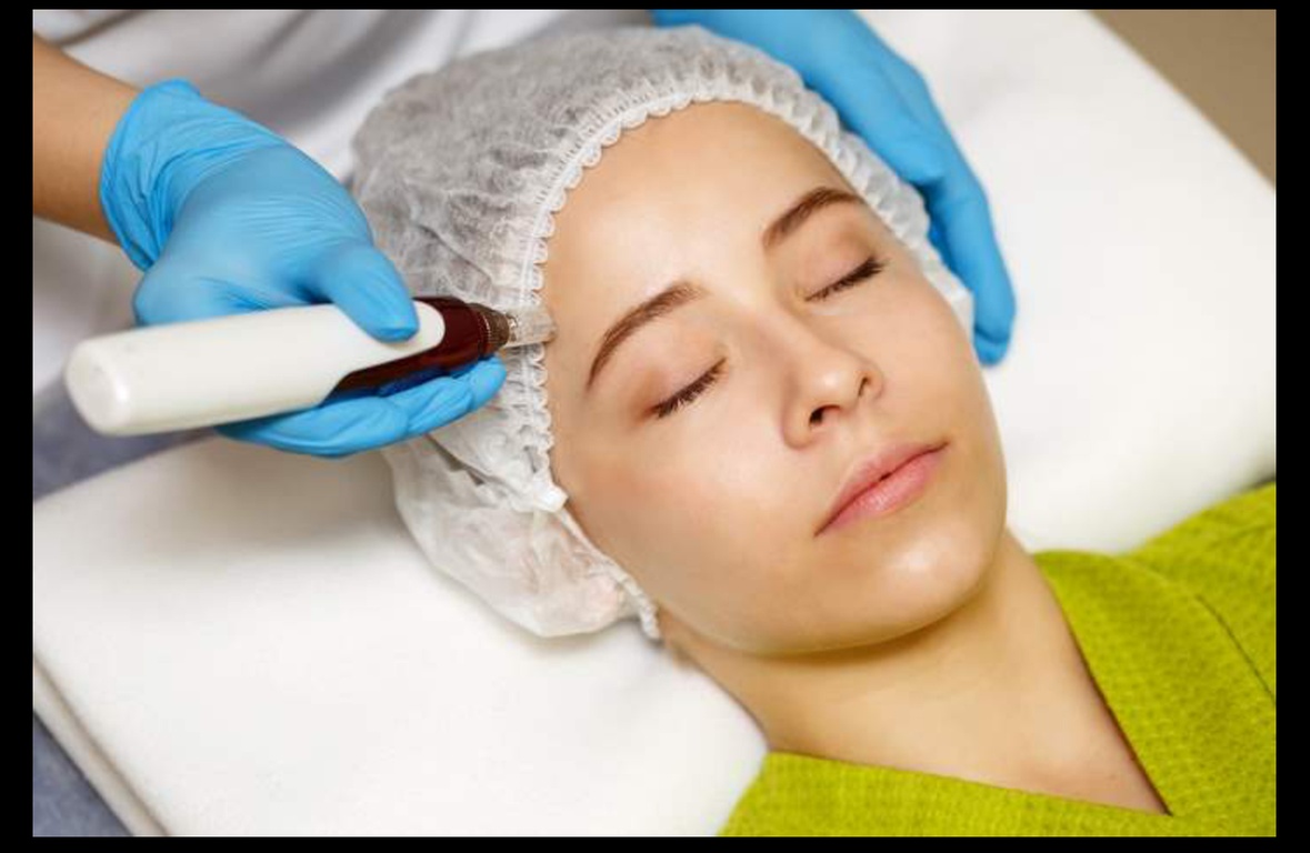 Up to 56% Off on Micro-Needling at Elite Medical Group Pc Clifton