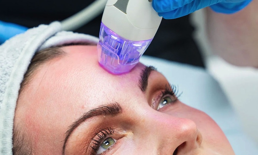 Image 2: Up to 55% Off on Micro-Needling at UK Aesthetics Lounge