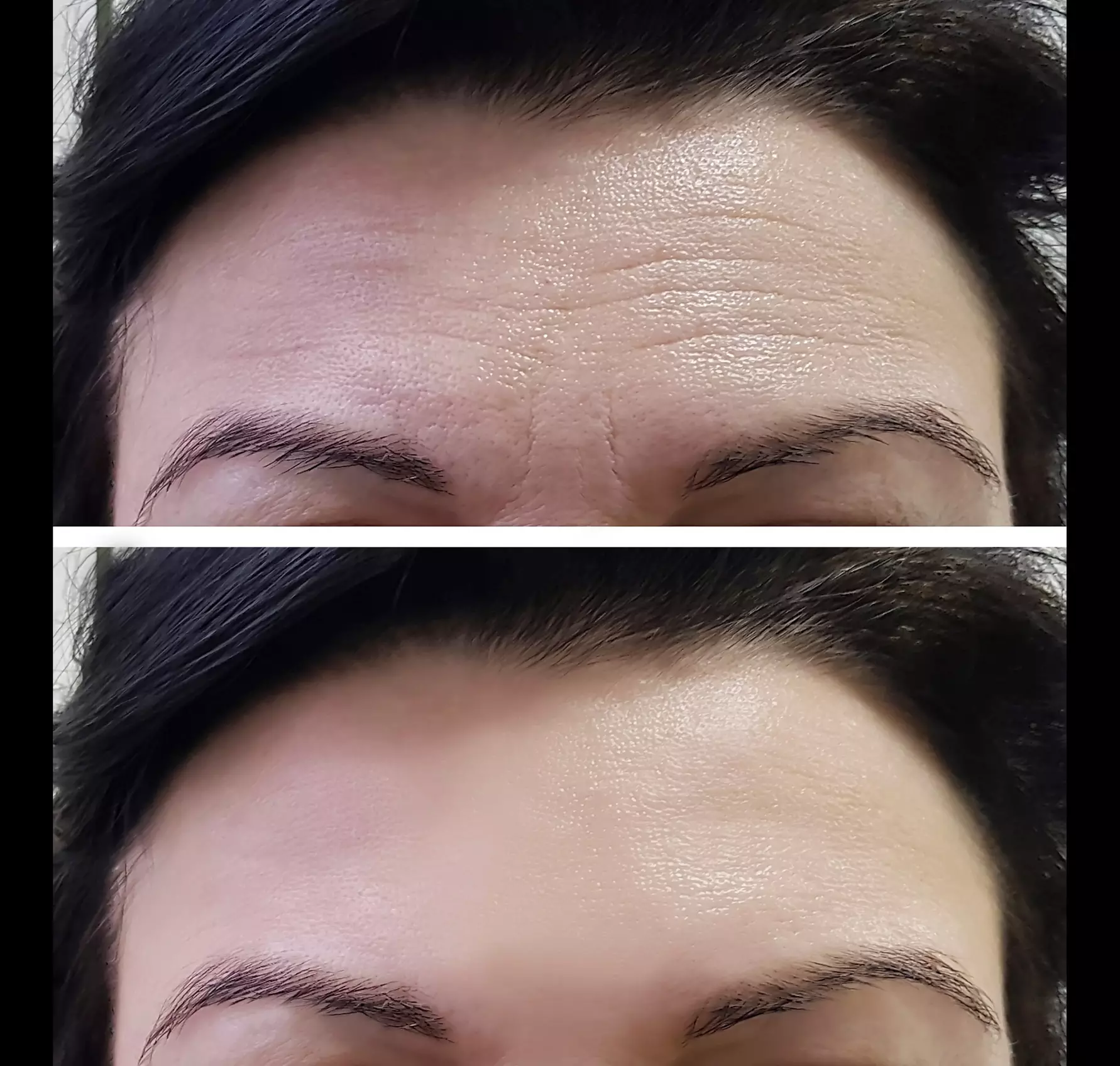Up to 56% Off on Facelift - Non-Surgical at Refined Physique - Second Medium