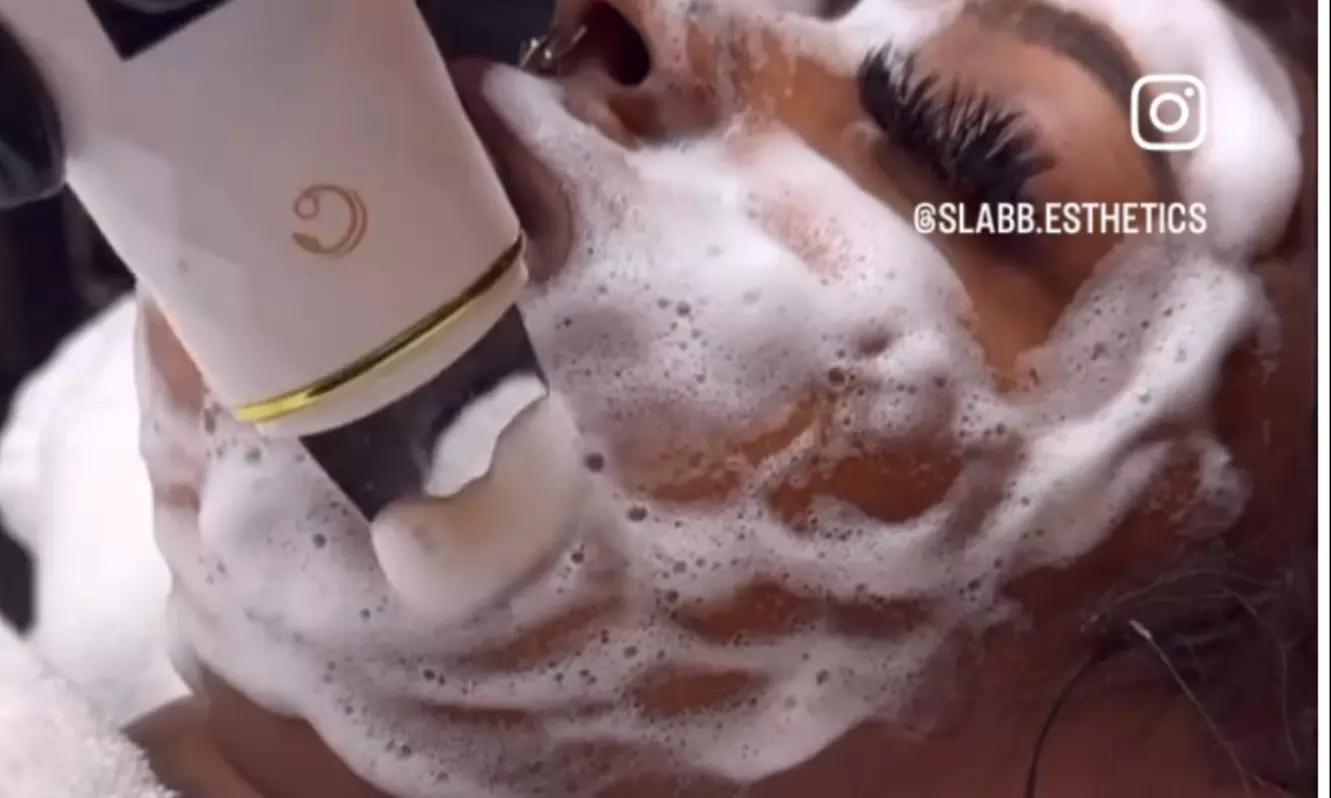 Microdermabrasion Facial or Acne Treatment Facial with High Frequency