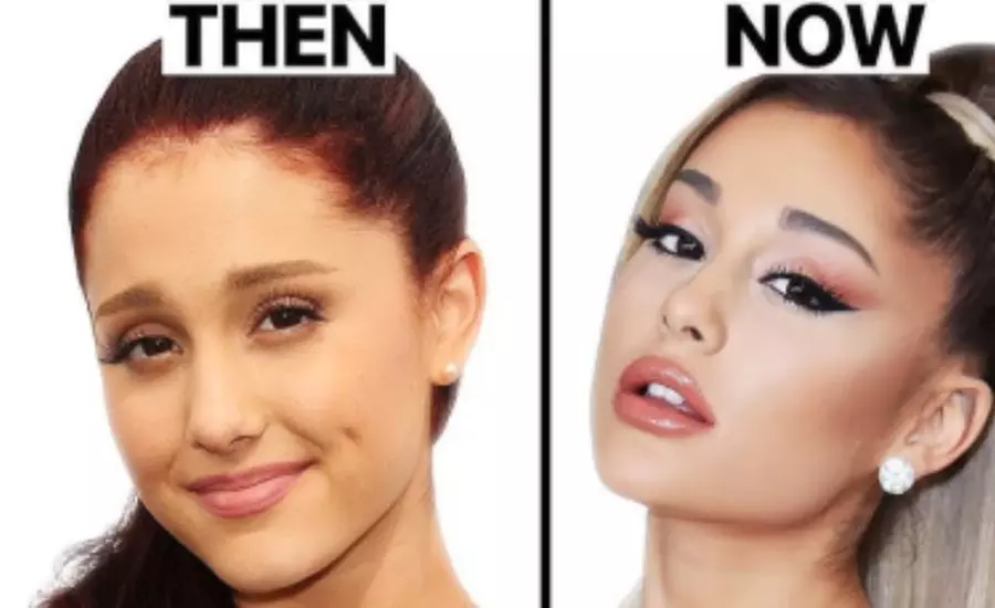 Celebrity-Coveted Cheek Pop or Snatched Jawline with PDO Threads