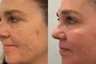 Transform Your Skin with One or Three CO2 Skin-Resurfacing Sessions at Amora Med Spa (Up to 77% Off) - Second Medium