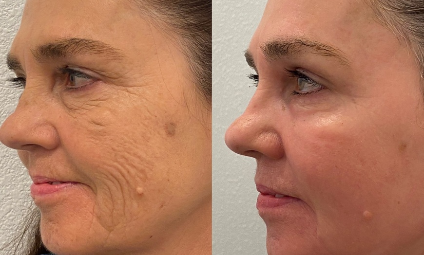 Image 3: Transform Your Skin with One or Three CO2 Skin-Resurfacing Sessions