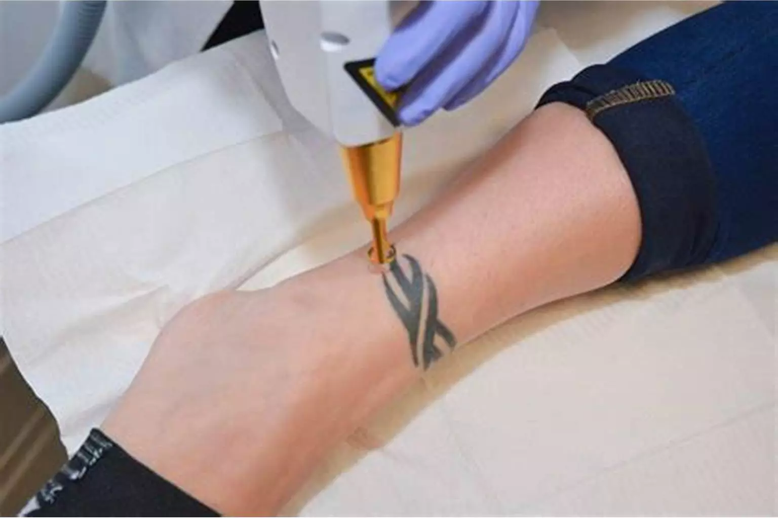Three laser tattoo removal sessions for medium, mini, or small areas
