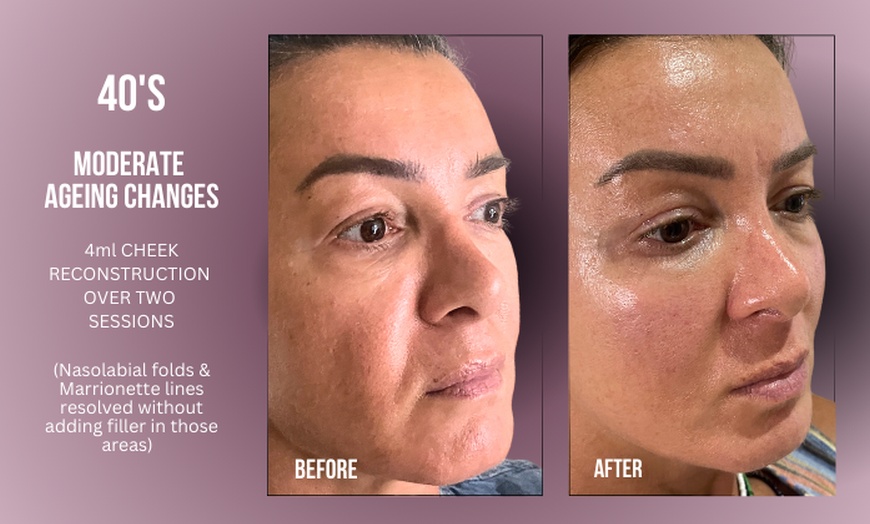 Image 5: Up to 38% Off on Injection - Dermal Filler at Divine Aesthetics Clinic London