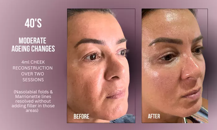 Up to 38% Off on Injection - Dermal Filler at Divine Aesthetics Clinic London