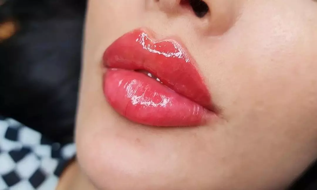 Up to 10% Off on Lip Enhancement at Utopia Aesthetics - Primary Image