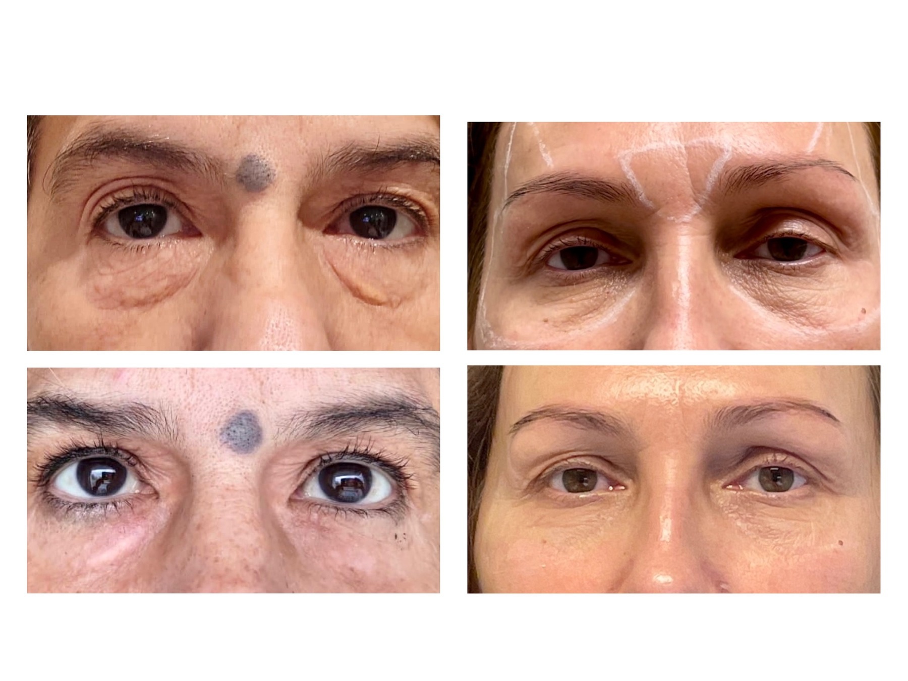 Up to 46% Off on Injection - Plasma