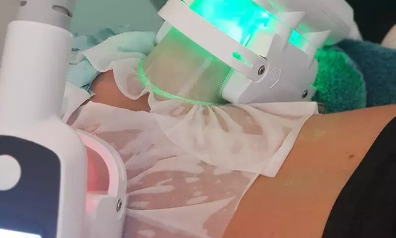 Disfruta de hasta 2 sesiones de criolipólisis en MCLaser con 50% de descuento - Primary Image