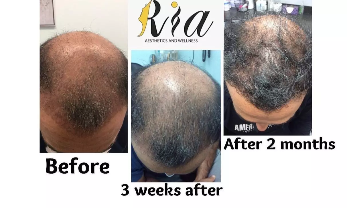 Up to 52% Off on Hair Restoration - Non-Surgical at Ria Aesthetics and Wellness - Primary Image