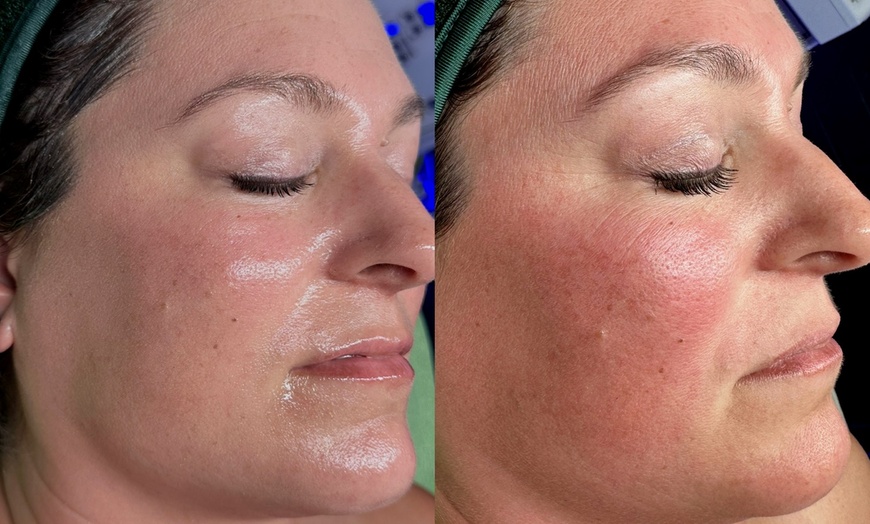 Image 1: Experience 90 Min LED, Peptide Facial or Deep Cleaning Facial!