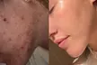 Up to 53% Off on Acne Treatment at Complexion Esthetician - Second Medium