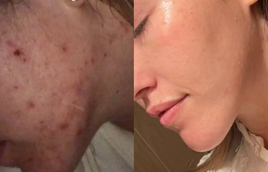 Up to 47% Off on Acne Treatment at Complexion Esthetician