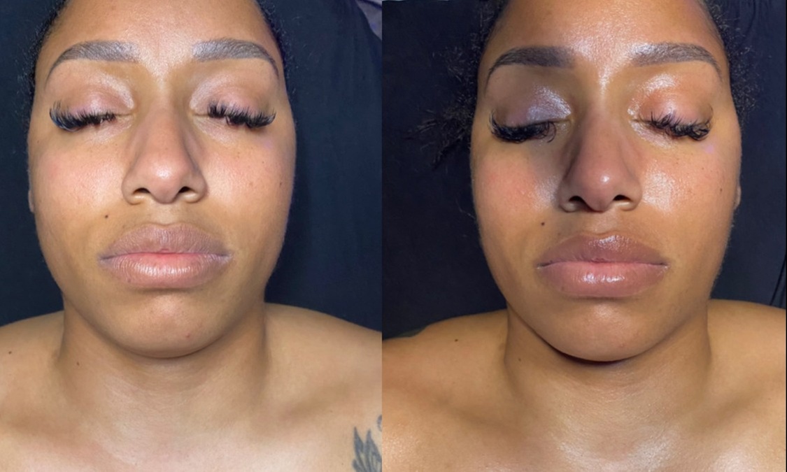 Up to 30% Off on Microdermabrasion at L'orange Aesthetics - Primary Image