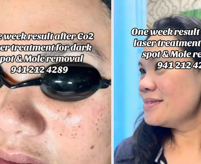 Up to 47% Off on Laser Skin Resurfacing at Hang's Spa