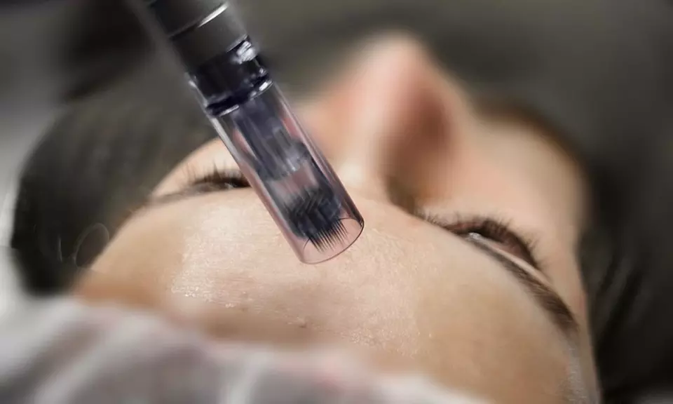Up to 35% Off on Micro-Needling at Institut Medico Esthetique - Primary Image