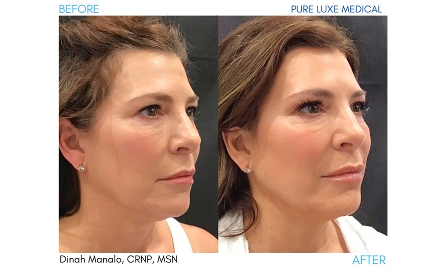Image 9: 20 Units of Botox for Frown Line or Crow's Feet or Juvéderm & More