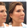 Image 9: 20 Units of Botox for Frown Line or Crow's Feet or Juvéderm & More