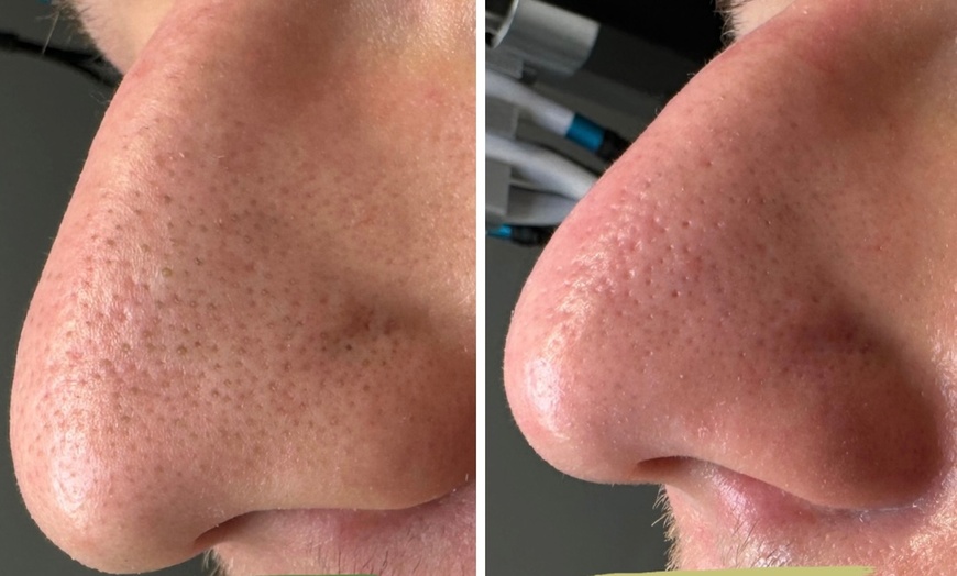 Image 4: Gesichtsreinigung / Aqua Facial / Microneedling / Microdermabrasion