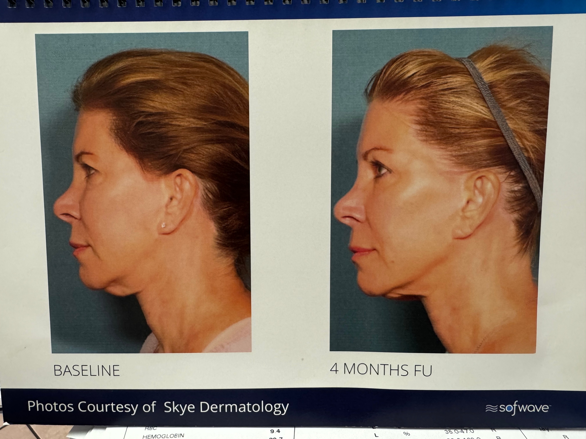 SofWave Non-Surgical Facelift for Under Eye or Jaw Treatment
