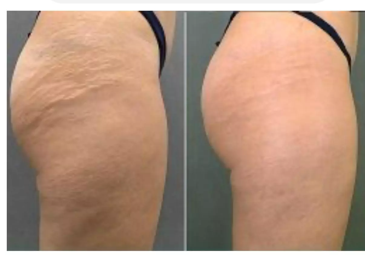 Up to 60% Off on Stretch Mark Removal at A Z Hair Salon - Primary Image