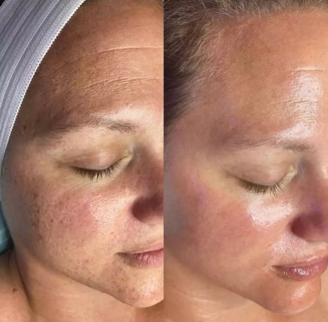 Up to 60% Off on Facial - HydraFacial at Aesthetics By Shanty