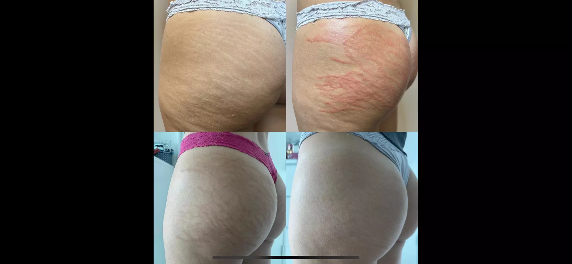 Up to 30% Off on Stretch Mark Removal at SkynRX - Primary Image
