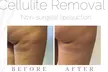 Up to 30% Off on Fat / Cellulite Reduction - Non-Branded at Feluxe LTD - Image 3