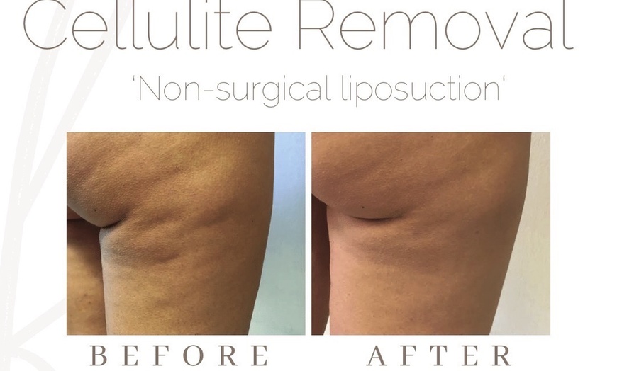 Image 3: Fat / Cellulite Reduction - Non-Branded at Feluxe LTD