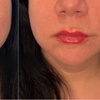 Image 8: Up to 26% Off on Injection - Filler and Freezer at Age Management Optimal Wellness